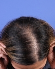 Before Hair Transplant&nbsp;Hair Thinning